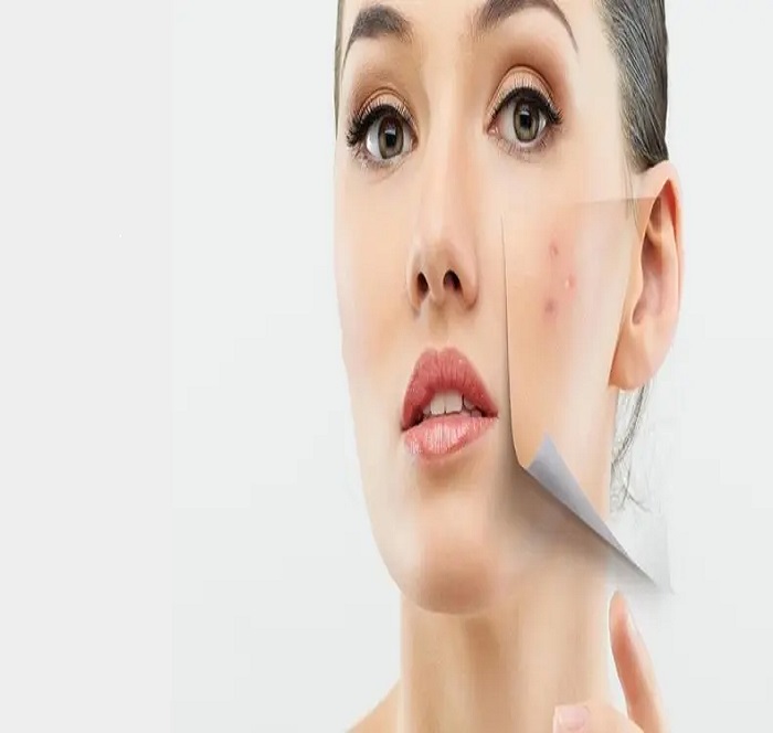 هر آنچه که درباره کرم ضد جوش باید بدانید